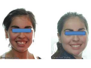 resultados con tratamiento de brackets