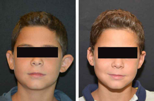 Otoplastia niños