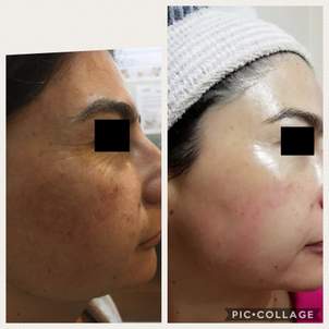 Peeling