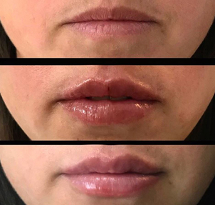 Candidatos para el aumento de labios