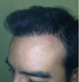 resultados definitivos implante capilar