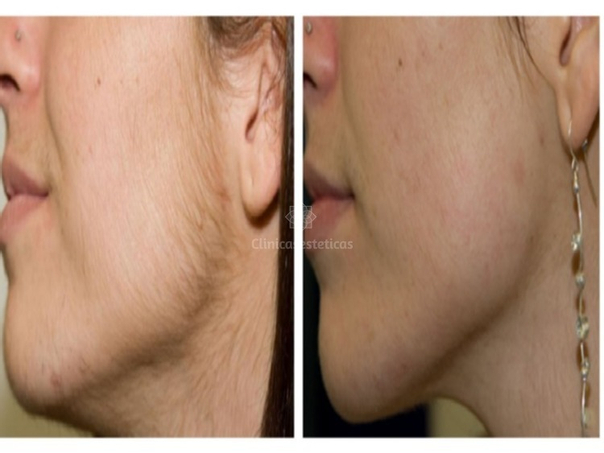 Antes y después de la depilación láser