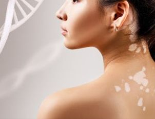 ¿Qué es el Vitíligo?