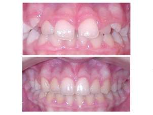 Tratamiento de odontopediatría