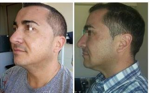 Resultados de los hilos tensores