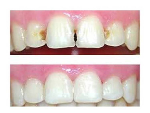 ¿Cuáles son los principales resultados de este tratamiento?