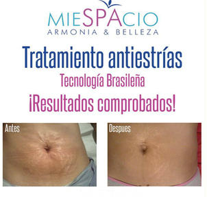 Antes y después de eliminar estrías