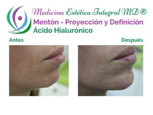Antes y después aumento mentón