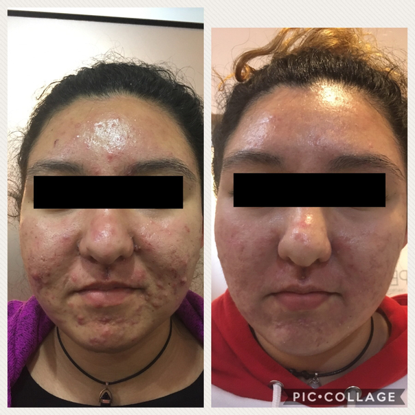 Antes y después de tratamiento de acné