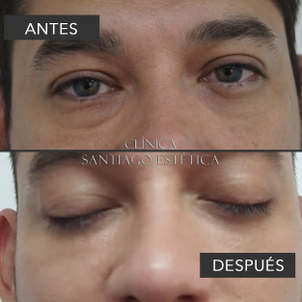 Resultados blefaroplastia