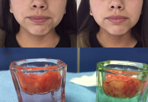 Grasa eliminada por las bolas de bichat