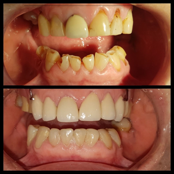 antes y después de una endodoncia