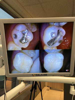 endodoncia en chile