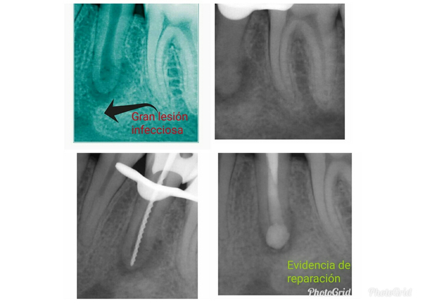 Caso clínico de una endodoncia