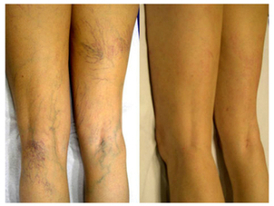 Antes y después tratamiento várices