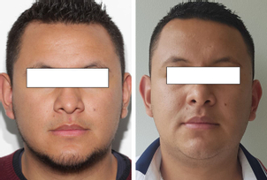 Resultados bichectomía