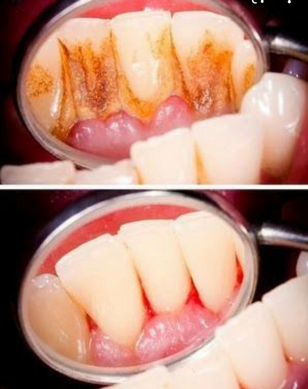 limpieza dental en chile