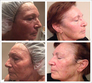 ¿Cuáles son los principales cuidados post tratamiento que debe tener en cuenta el paciente?