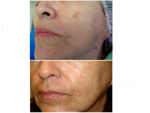 Por que aparecen las manchas en la cara