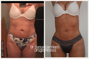 Antes y despues de lipoescultura