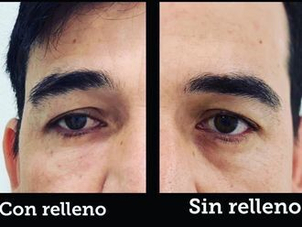 antes y después ojeras