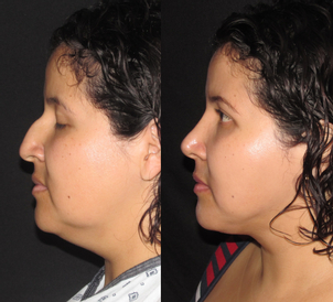 Rinoplastia antes y después