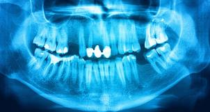 reconstrucción dental