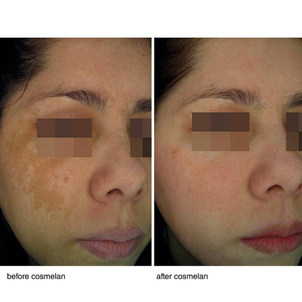 Qué son las manchas de la piel