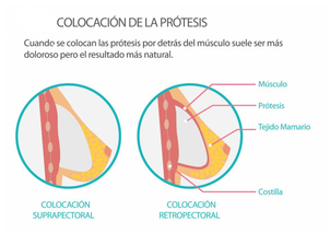 Colocación prótesis de mama