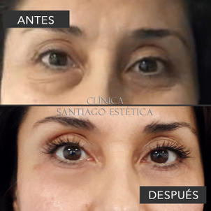 Mujer antes y después blefaroplastia