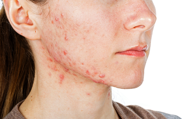 efectos secundarios tratamiento acne