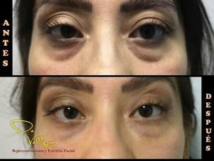 antes y después ojeras