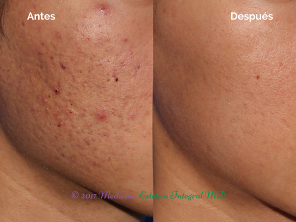 Antes y después de tratamiento de acné
