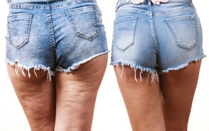Causas de las celulitis