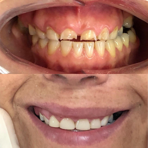 resultados de carillas