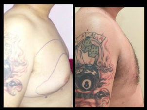 Antes y después ginecomastia
