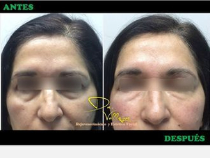 antes y después ojeras