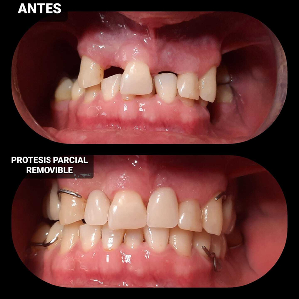 ¿Qué son las prótesis dentales?