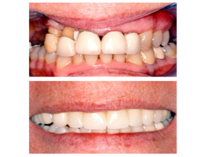 ¿Cómo es la recuperación de un tratamiento de periodoncia?