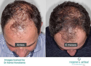 implante capilar en chile