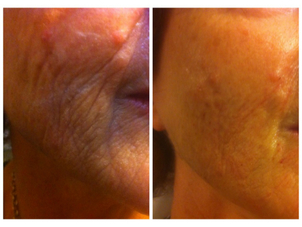 Beneficios de Rejuvenecimiento facial