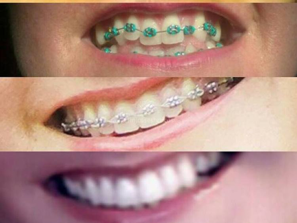 ortodoncia dental con brackets