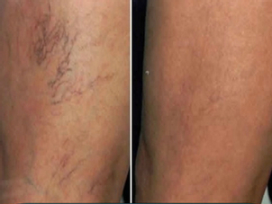 Resultados eliminación de várices