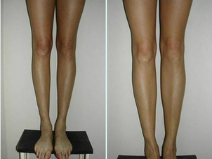 Resultados del aumento de gemelos