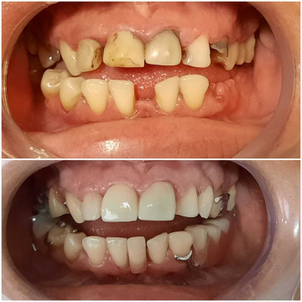 ¿Cómo es la recuperación luego de un tratamiento de prótesis dentales?