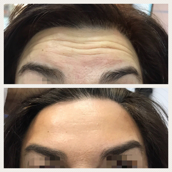 antes y después botox