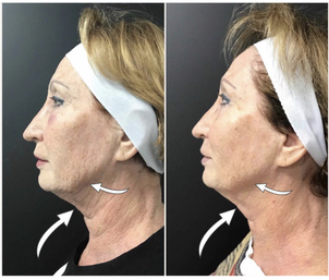 antes y después de lifting