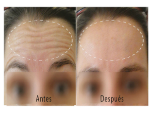 antes y después de usar mesoterapia