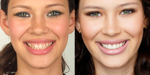 Antes y después de las carillas de porcelana