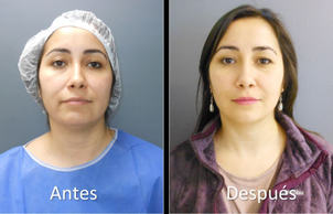 Resultado de la cirugía de eliminación bolas de bichat